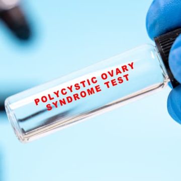 Le syndrome des ovaires polykystiques renommé : un changement nécessaire