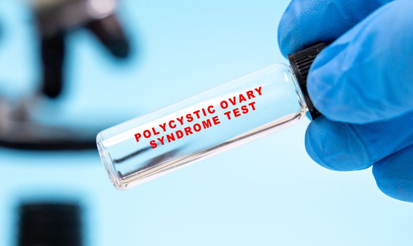 Polycystic ovary syndrome saliva test Le SOPK devient le Syndrome Métabolique Ovarien Polyendocrinien