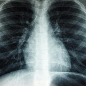 Un nouveau programme de dépistage du cancer du poumon en France