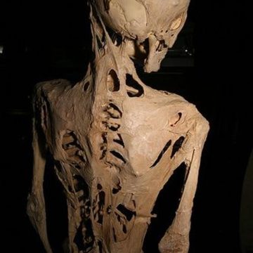ba384468-4c38-4444-9198-0d89e13bf958 Comprendre la fibrodysplasie ossifiante progressive: une maladie génétique rare