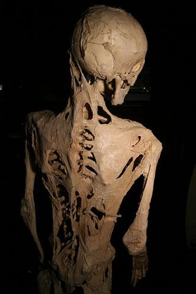 ba384468-4c38-4444-9198-0d89e13bf958 Comprendre la fibrodysplasie ossifiante progressive: une maladie génétique rare