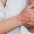 Une avancée génétique dans le traitement du psoriasis résistant