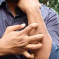 Comment gérer efficacement les piqûres d&rsquo;insectes