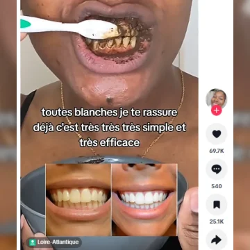 Les risques des recettes maison pour le blanchiment des dents